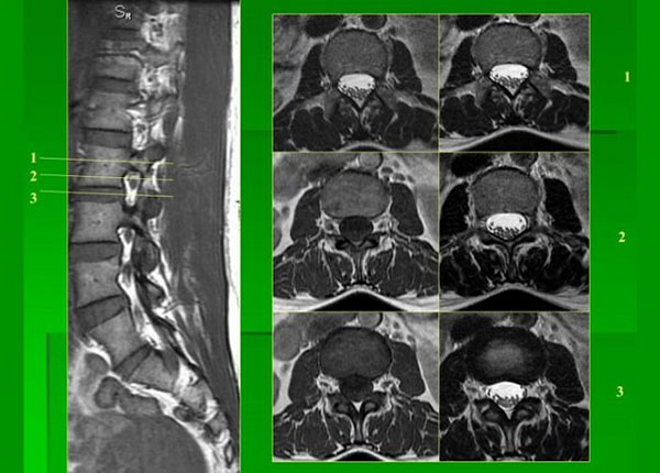 Hình ảnh chụp MRI thoát vị đĩa đệm có chất lượng cao, rất rõ nét