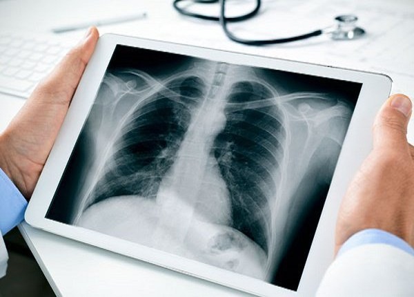 Chụp X-quang phổ biến nhất trong các phương pháp chẩn đoán hình ảnh