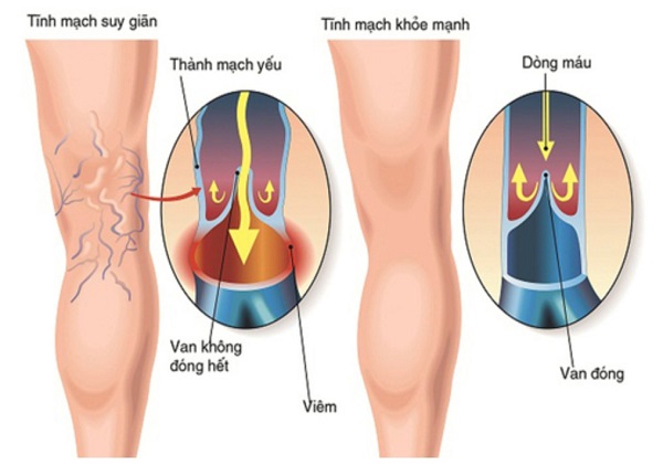 <center><em>Suy tĩnh mạch chân dưới là tình trạng phổ biến khi van tĩnh mạch không hoạt động đúng cách</em></center>