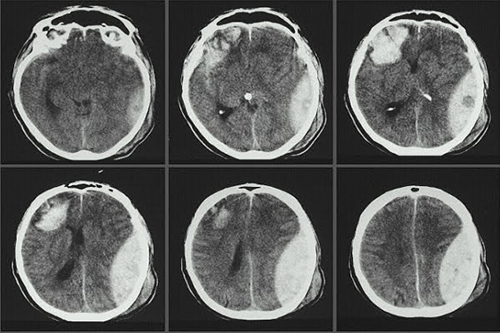 Kỹ thuật chụp cắt lớp vi tính sọ não 