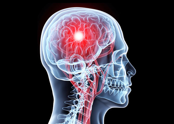 Chấn thương sọ não mức nhẹ là gì?