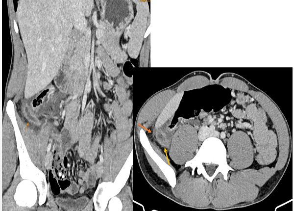 <center><em>Hình ảnh viêm ruột thừa cấp của một bệnh nhân</em></center>