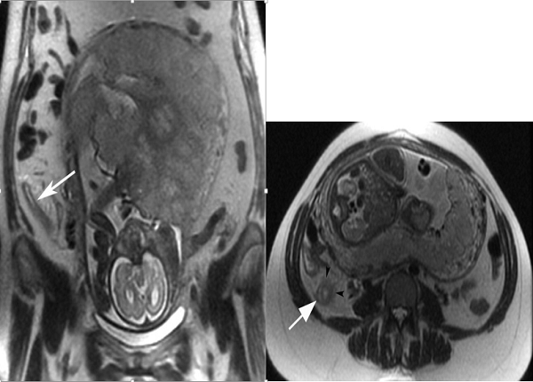 <center><em>Hình ảnh viêm ruột thừa trên MRI của bệnh nhân nữ đang mang thai không chụp được bằng phương pháp CLVT</em></center>