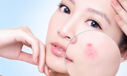 Có nhiều cách để trị mụn cấp tốc tại nhà