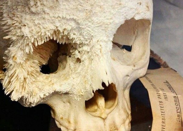 Hình ảnh ung thư xương hộp sọ