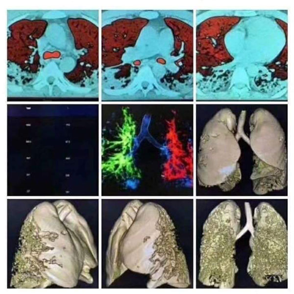 Hình ảnh phổi bệnh nhân covid-19 được đồ họa dựa vào kỹ thuật hình ảnh y học