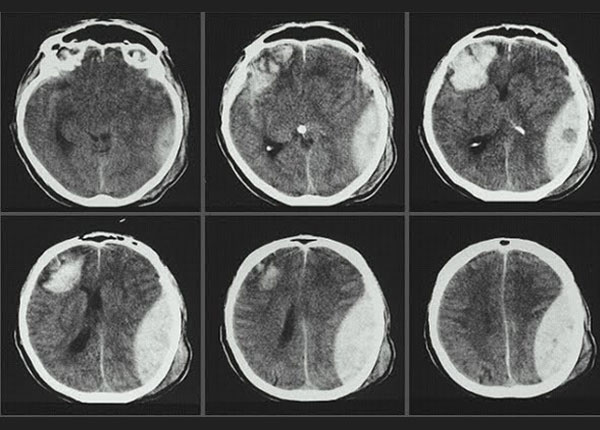 Não người bị chấn thương chụp dựa vào Kỹ thuật hình ảnh y học
